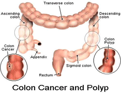 Ảnh 4 của Colon cancer